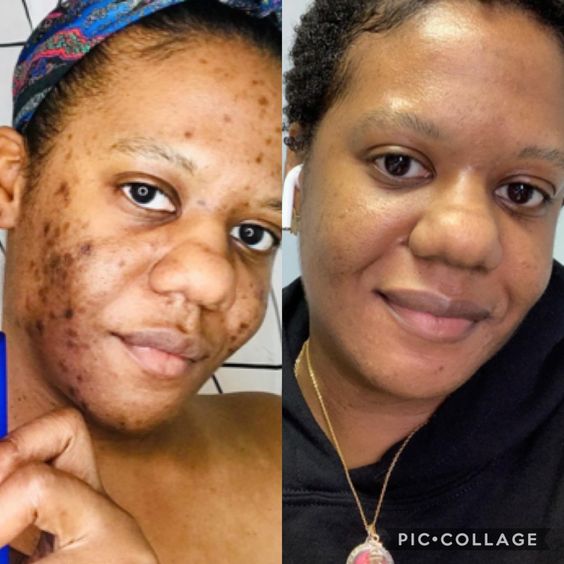 BENEFICIEZ DE 50% DE REDUCTION AUJOURD'HUI POUR CETTE CREME DE VISAGE QUI A DEJA FAIT SES PREUVES SUR TOUT LE CONTINENT